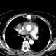 Pneumonia, mediastinitis, mediastinal abscess: CT - Computed tomography